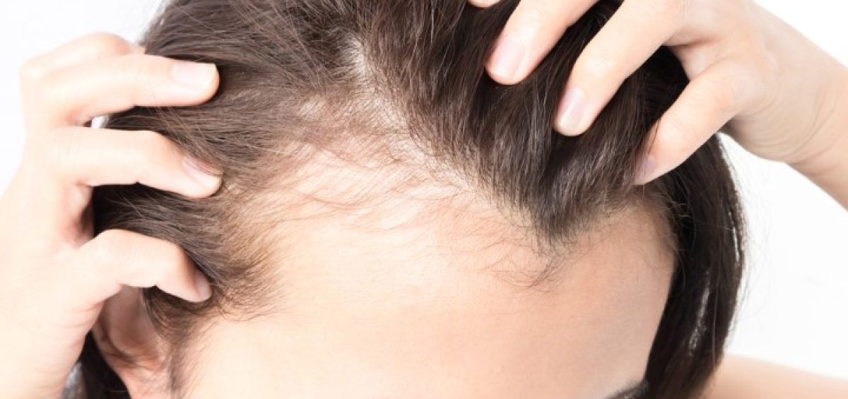 Imagem de Alopecia Androgenética (Calvície)