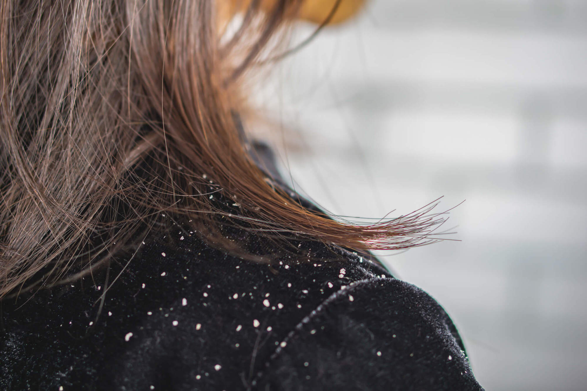 Imagem do procedimento Doenças do Cabelo