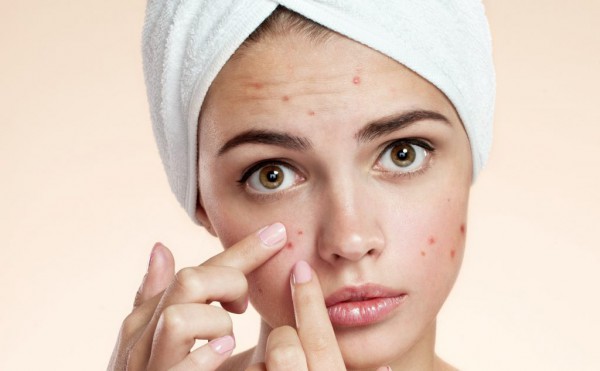 Acne Adulta na Quarentena: Você não está sozinha!