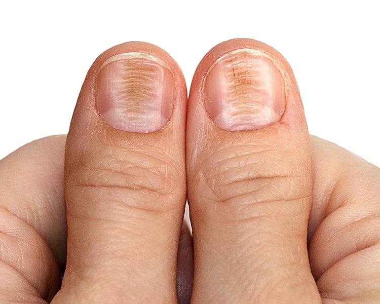 Imagem de  Doenças das Unhas